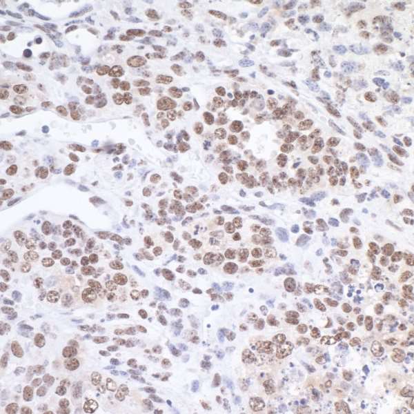 FUS / TLS Antibody - Detection of mouse FUS by immunohistochemistry. Sample: FFPE section of mouse teratoma Antibody: Affinity purified rabbit anti-FUS used at 1:5,000 (0.2µg/ml). Detection: DAB