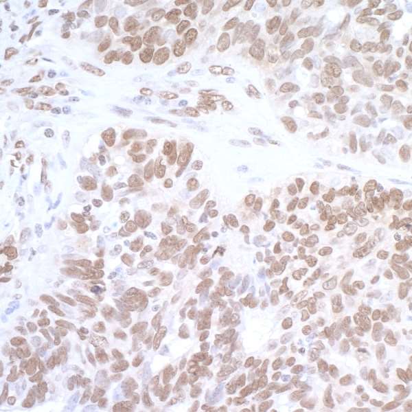 FUS / TLS Antibody - Detection of human FUS by immunohistochemistry. Sample: FFPE section of human ovarian carcinoma. Antibody: Affinity purified rabbit anti-FUS used at of 1:5,000 (0.2µg/ml). Detection: DAB