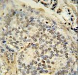 FUS / TLS Antibody - FUS antibody immunohistochemistry of formalin-fixed and paraffin-embedded human prostate carcinoma followed by peroxidase-conjugated secondary antibody and DAB staining.