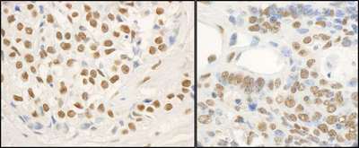FUS / TLS Antibody - Detection of Human and Mouse FUS by Immunohistochemistry. Sample: FFPE section of human breast carcinoma (left) and mouse teratoma (right). Antibody: Affinity purified rabbit anti-FUS used at a dilution of 1:5000 (0.2and 1:1000 (1 Detection: DAB.