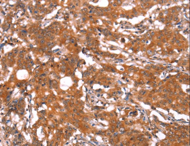 FUT1 / HSC Antibody - Immunohistochemistry of paraffin-embedded Human gastric cancer using FUT1 Polyclonal Antibody at dilution of 1:30.
