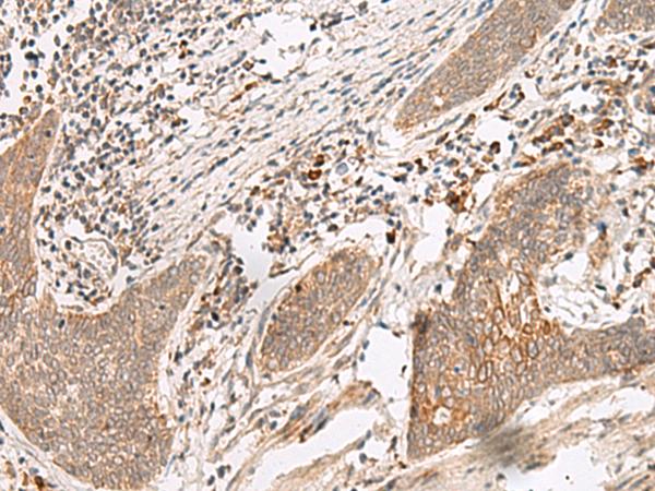 FUT10 Antibody - Immunohistochemistry of paraffin-embedded Human esophagus cancer tissue  using FUT10 Polyclonal Antibody at dilution of 1:45(×200)