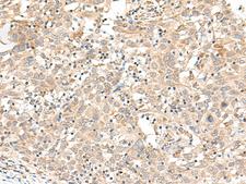 FUT3 Antibody - Immunohistochemistry of paraffin-embedded Human cervical cancer tissue  using FUT3 Polyclonal Antibody at dilution of 1:35(×200)