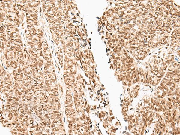 FUT3 Antibody - Immunohistochemistry of paraffin-embedded Human ovarian cancer tissue  using FUT3 Polyclonal Antibody at dilution of 1:35(×200)