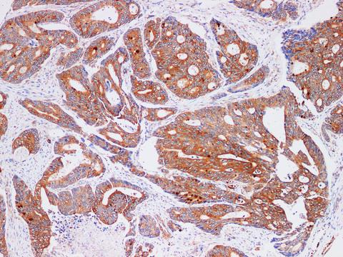 FUT3 Antibody - Immunohistochemistry of paraffin-embedded Human Colorectal cancer using FUT3 Polyclonl Antibody at dilution of 1:200(100×).