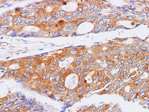 FUT3 Antibody - Immunohistochemistry of paraffin-embedded Human Colorectal cancer using FUT3 Polyclonl Antibody at dilution of 1:200(400×).
