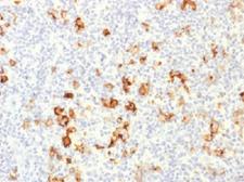 FUT4 / CD15 Antibody - IHC testing of FFPE human Hodgkin's lymphoma with CD15 antibody. Required HIER: boil tissue sections in 10mM Tris with 1mM EDTA, pH 9, for 10-20 min.