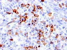 FUT4 / CD15 Antibody - Formalin-fixed, paraffin-embedded human Hodgkin's lymphoma stained with CD15 antibody (BRA-4F1).  This image was taken for the unmodified form of this product. Other forms have not been tested.