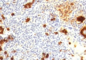 FUT4 / CD15 Antibody - IHC testing of FFPE human Hodgkin's lymphoma and CD15 antibody (CDLA15-1).  This image was taken for the unmodified form of this product. Other forms have not been tested.
