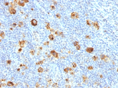 FUT4 / CD15 Antibody - Formalin-fixed, paraffin-embedded human Hodgkin's Lymphoma stained with CD15 Rabbit Recombinant Monoclonal Antibody (FUT4/1478R).