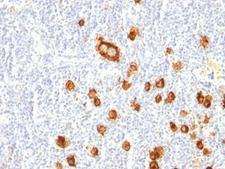FUT4 / CD15 Antibody - Formalin-fixed, paraffin-embedded human Hodgkin's lymphoma stained with CD15 antibody (FUT4/815).  This image was taken for the unmodified form of this product. Other forms have not been tested.
