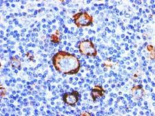 FUT4 / CD15 Antibody - Formalin-fixed, paraffin-embedded human Hodgkin's lymphoma stained with CD15 antibody (Leu-M1).  This image was taken for the unmodified form of this product. Other forms have not been tested.