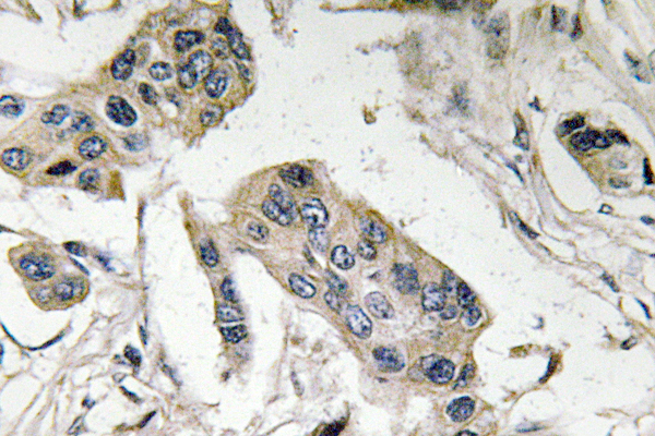 FUT4 / CD15 Antibody - IHC of FucT-IV (E71) pAb in paraffin-embedded human breast carcinoma tissue.