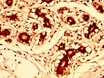 FUT8 Antibody - Immunohistochemistry image at a dilution of 1:300 and staining in paraffin-embedded human breast cancer performed on a Leica BondTM system. After dewaxing and hydration, antigen retrieval was mediated by high pressure in a citrate buffer (pH 6.0) . Section was blocked with 10% normal goat serum 30min at RT. Then primary antibody (1% BSA) was incubated at 4 °C overnight. The primary is detected by a biotinylated secondary antibody and visualized using an HRP conjugated SP system.