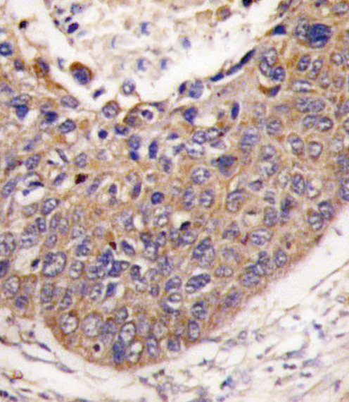 FXN / Frataxin Antibody - Formalin-fixed and paraffin-embedded human lung carcinoma tissue reacted with FXN antibody , which was peroxidase-conjugated to the secondary antibody, followed by DAB staining. This data demonstrates the use of this antibody for immunohistochemistry; clinical relevance has not been evaluated.