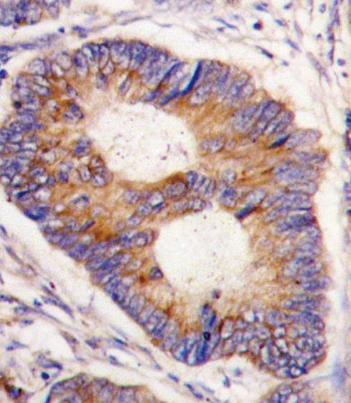 FXN / Frataxin Antibody - Formalin-fixed and paraffin-embedded human colon carcinoma tissue reacted with FXN antibody , which was peroxidase-conjugated to the secondary antibody, followed by DAB staining. This data demonstrates the use of this antibody for immunohistochemistry; clinical relevance has not been evaluated.