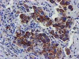 FXN / Frataxin Antibody - IHC of paraffin-embedded Carcinoma of Human lung tissue using anti-FXN mouse monoclonal antibody.
