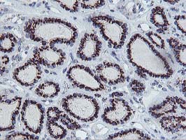 FXN / Frataxin Antibody - IHC of paraffin-embedded Carcinoma of Human thyroid tissue using anti-FXN mouse monoclonal antibody.