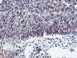 FXN / Frataxin Antibody - IHC of paraffin-embedded Carcinoma of Human bladder tissue using anti-FXN mouse monoclonal antibody.