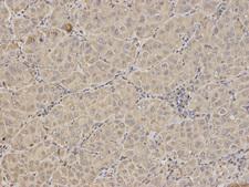 FXN / Frataxin Antibody - Immunohistochemistry of paraffin-embedded human liver cancer using FXN antibody at dilution of 1:100 (200x lens).