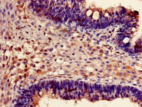 FXR1 Antibody - Immunohistochemistry of paraffin-embedded human ovarian cancer using FXR1 Antibody at dilution of 1:100