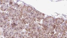 FXR1 Antibody - 1:100 staining human pancreas carcinoma tissue by IHC-P. The sample was formaldehyde fixed and a heat mediated antigen retrieval step in citrate buffer was performed. The sample was then blocked and incubated with the antibody for 1.5 hours at 22°C. An HRP conjugated goat anti-rabbit antibody was used as the secondary.