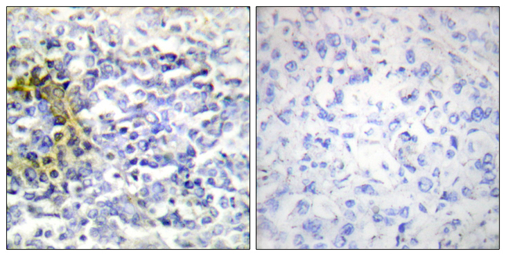 FXR2 Antibody - Immunohistochemistry analysis of paraffin-embedded human lung carcinoma tissue, using FXR2 Antibody. The picture on the right is blocked with the synthesized peptide.