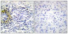 FXR2 Antibody - Immunohistochemistry analysis of paraffin-embedded human lung carcinoma tissue, using FXR2 Antibody. The picture on the right is blocked with the synthesized peptide.