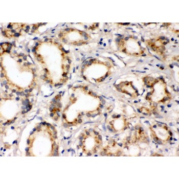 FXYD1 / Phospholemman Antibody - FXYZ1 antibody IHC-paraffin. IHC(P): Human Prostatic Cancer Tissue.