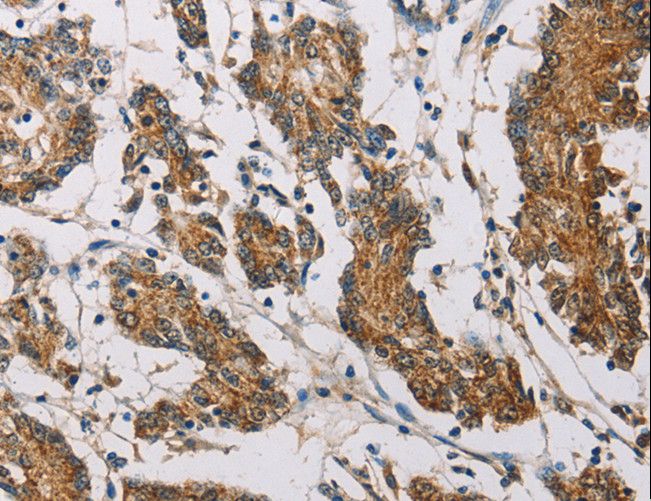 FXYD1 / Phospholemman Antibody - Immunohistochemistry of paraffin-embedded Human colon cancer using FXYD1 Polyclonal Antibody at dilution of 1:60.