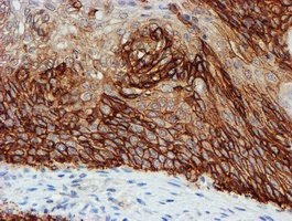FXYD3 Antibody - IHC of paraffin-embedded Carcinoma of Human bladder tissue using anti-FXYD3 mouse monoclonal antibody. (Heat-induced epitope retrieval by 10mM citric buffer, pH6.0, 100C for 10min).