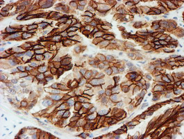 FXYD3 Antibody - IHC of paraffin-embedded Adenocarcinoma of Human ovary tissue using anti-FXYD3 mouse monoclonal antibody. (Heat-induced epitope retrieval by 10mM citric buffer, pH6.0, 100C for 10min).