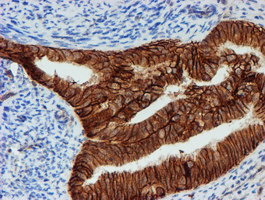 FXYD3 Antibody - IHC of paraffin-embedded Adenocarcinoma of Human endometrium tissue using anti-FXYD3 mouse monoclonal antibody. (Heat-induced epitope retrieval by 10mM citric buffer, pH6.0, 100C for 10min).