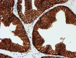 FXYD3 Antibody - IHC of paraffin-embedded Carcinoma of Human prostate tissue using anti-FXYD3 mouse monoclonal antibody. (Heat-induced epitope retrieval by 10mM citric buffer, pH6.0, 100C for 10min).