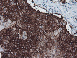 FXYD3 Antibody - IHC of paraffin-embedded Carcinoma of Human lung tissue using anti-FXYD3 mouse monoclonal antibody.