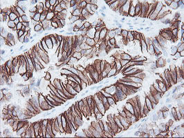 FXYD3 Antibody - IHC of paraffin-embedded Adenocarcinoma of Human ovary tissue using anti-FXYD3 mouse monoclonal antibody.