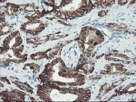 FXYD3 Antibody - IHC of paraffin-embedded Carcinoma of Human prostate tissue using anti-FXYD3 mouse monoclonal antibody.