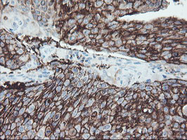 FXYD3 Antibody - IHC of paraffin-embedded Carcinoma of Human bladder tissue using anti-FXYD3 mouse monoclonal antibody.