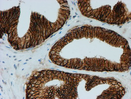 FXYD3 Antibody - IHC of paraffin-embedded Carcinoma of Human prostate tissue using anti-FXYD3 mouse monoclonal antibody. (Heat-induced epitope retrieval by 10mM citric buffer, pH6.0, 100C for 10min).
