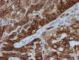 FXYD3 Antibody - IHC of paraffin-embedded Adenocarcinoma of Human ovary tissue using anti-FXYD3 mouse monoclonal antibody. (Heat-induced epitope retrieval by 10mM citric buffer, pH6.0, 100C for 10min).