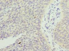 FXYD5 / Dysadherin Antibody - Immunohistochemistry of paraffin-embedded human cervical cancer at dilution 1:100