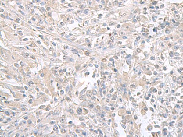 FXYD6 Antibody - Immunohistochemistry of paraffin-embedded Human liver cancer tissue  using FXYD6 Polyclonal Antibody at dilution of 1:65(×200)