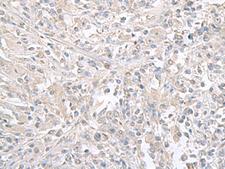 FXYD6 Antibody - Immunohistochemistry of paraffin-embedded Human liver cancer tissue  using FXYD6 Polyclonal Antibody at dilution of 1:65(×200)