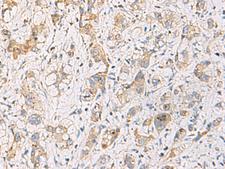 FYCO1 Antibody - Immunohistochemistry of paraffin-embedded Human liver cancer tissue  using FYCO1 Polyclonal Antibody at dilution of 1:110(×200)