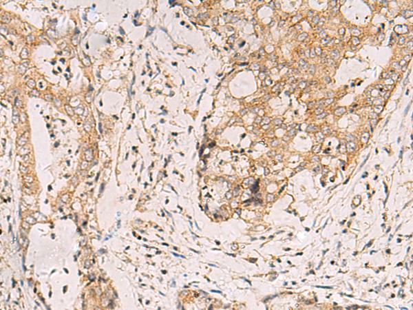 FYCO1 Antibody - Immunohistochemistry of paraffin-embedded Human cervical cancer tissue  using FYCO1 Polyclonal Antibody at dilution of 1:110(×200)