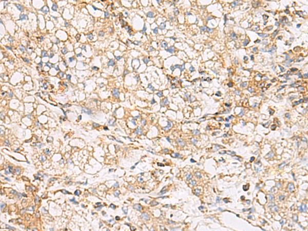FYCO1 Antibody - Immunohistochemistry of paraffin-embedded Human liver cancer tissue  using FYCO1 Polyclonal Antibody at dilution of 1:60(×200)