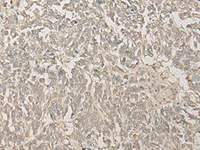 FYTTD1 Antibody - Immunohistochemistry of paraffin-embedded Human lung cancer tissue  using FYTTD1 Polyclonal Antibody at dilution of 1:30(×200)