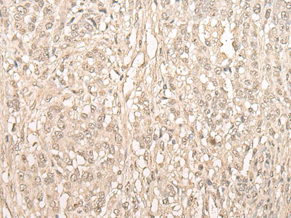 FYTTD1 Antibody - Immunohistochemistry of paraffin-embedded Human ovarian cancer tissue  using FYTTD1 Polyclonal Antibody at dilution of 1:30(×200)