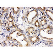 FZD1 / Frizzled 1 Antibody - Frizzled homolog 1 antibody IHC-paraffin. IHC(P): Human Prostatic Cancer Tissue.