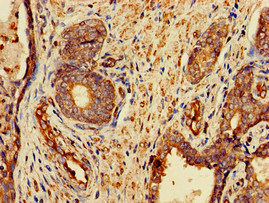 FZD1 / Frizzled 1 Antibody - Immunohistochemistry of paraffin-embedded human prostate cancer at dilution of 1:100